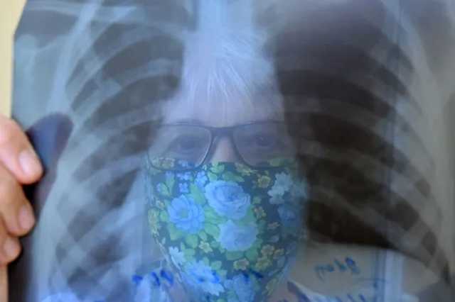 Как отличить коронавирус от рака легких: врач дал совет