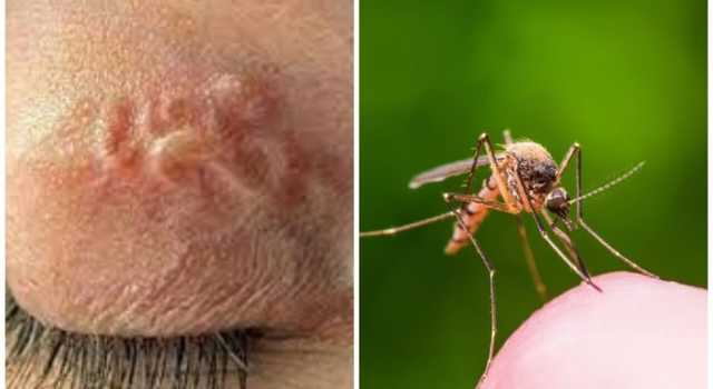 У трех киевлян обнаружили редкое заболевание: черви в глазах