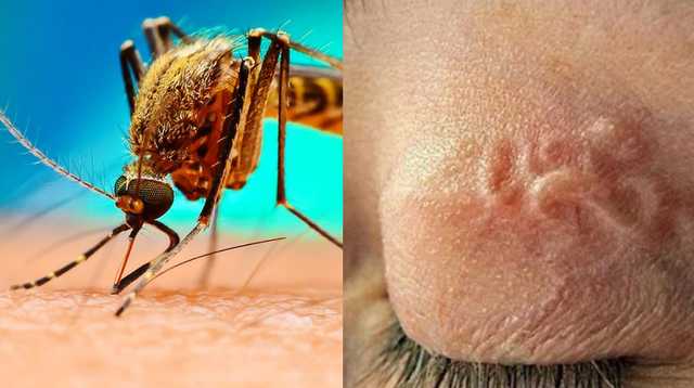 В Киеве зафиксированы случаи заражения «злой нитью», которую переносят комары