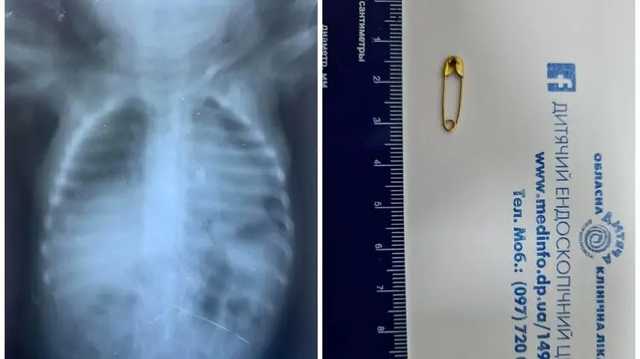 В Днепре спасли малыша, который вдохнул булавку во время игры