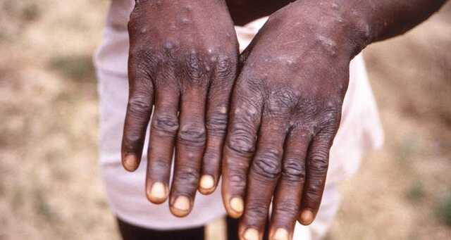 В Израиле зафиксирован первый случай подозрения на оспу обезьян