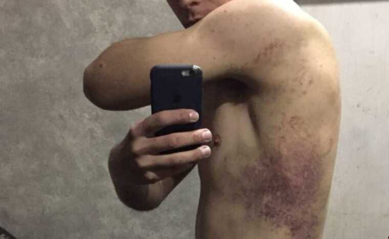 Колишні українські полонені розповіли про жорстокі тортури під час ув’язнення в Росії