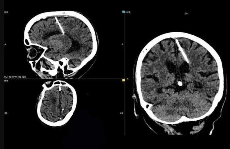 У мозку 80-річної росіянки знайшли голку. Так убивали дітей у голодні роки