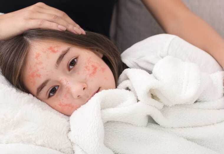 ВООЗ: Через зниження рівня вакцинації у світі зростає кількість смертей від кору