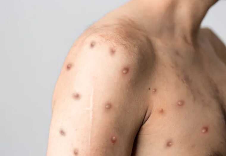 В Швеции зафиксировали первый случай обезьяньей оспы