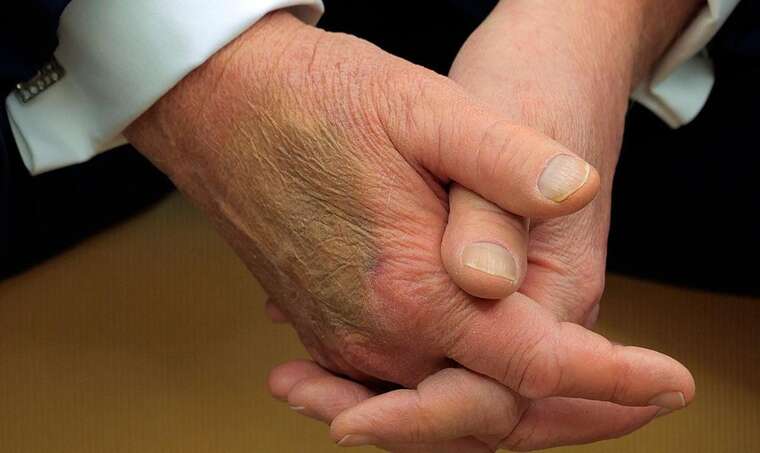 На правій руці Трампа помітили великий синяк: з’явився від «постійних рукостискань»