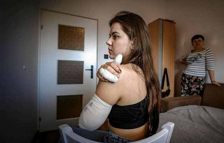 19-річна українка втратила руку на роботі в Польщі: проходить реабілітацію, готується до протезування