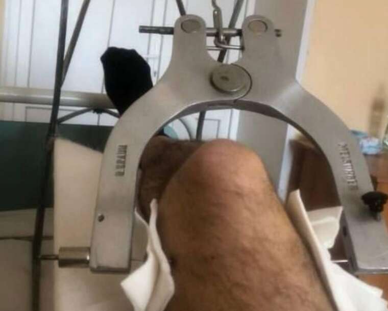 Втеча з переломом: мешканець Дніпра звинуватив військкома в насильницькій мобілізації