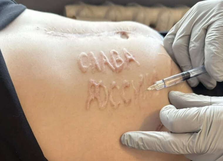 A Ukrainian soldier is having the inscription "glory to Russia" removed, which was burned into him while in captivity