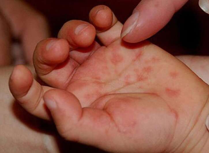 На Київщині спалах вірусу Коксакі: лікарі застерігають від самолікування