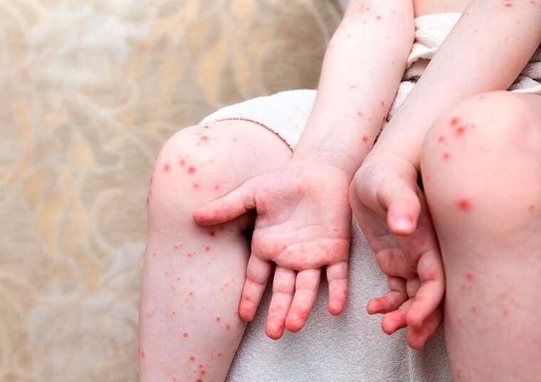 МОЗ повідомило про спалах вірусу Коксакі: 13 дітей захворіли, один залишається в лікарні