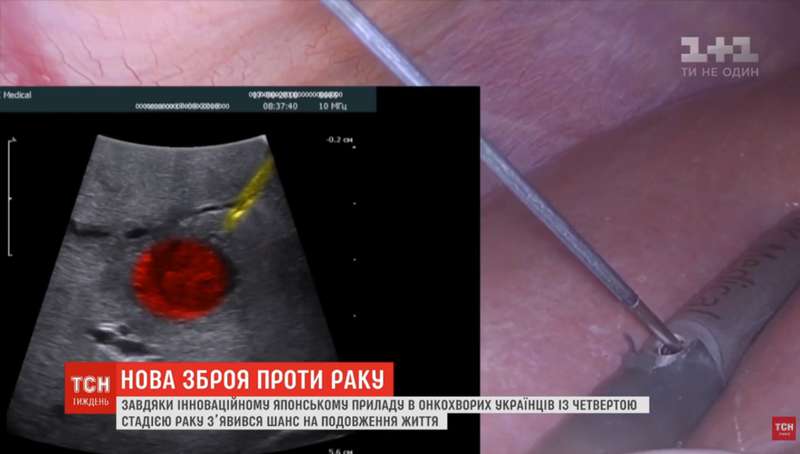 Прорыв в борьбе с раком: в Украине тестируют уникальную технику операции dqxikeidqxihuant