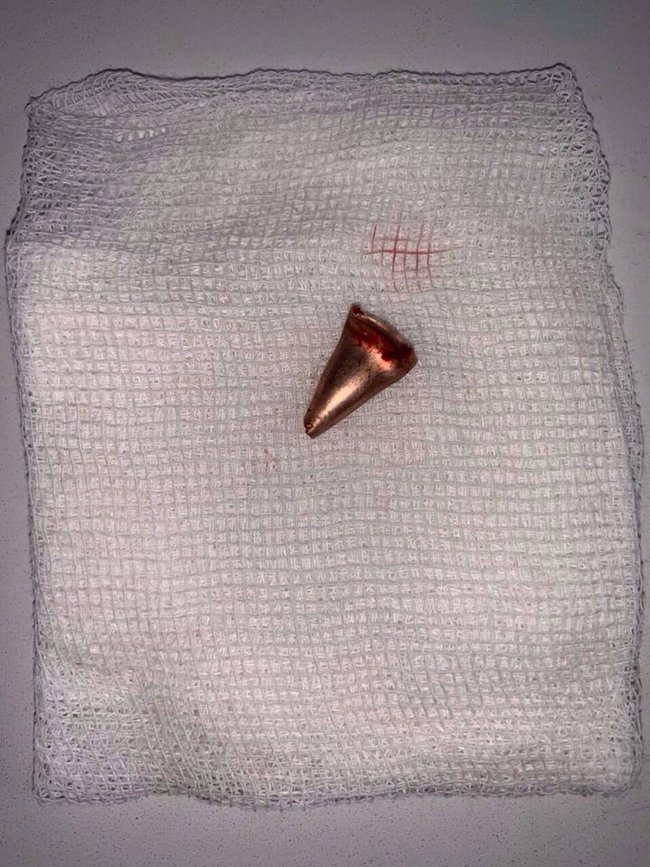 Врачи извлекли пулю из головы раненного украинского воина: у него появились признаки положительной динамики, - главврач больницы им. Мечникова Рыженко 01 Врачи извлекли пулю из головы раненного украинского воина: у него появились признаки положительной динамики, - главврач больницы им. Мечникова Рыженко 01 dqxikeidqxidqeant