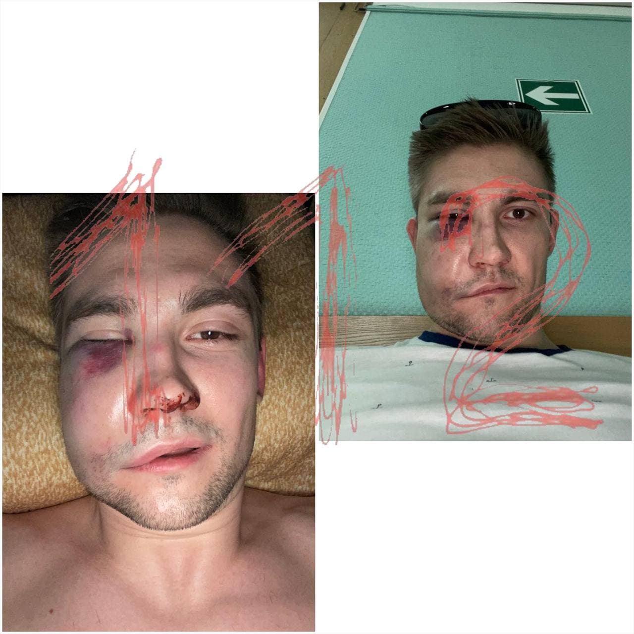 Фото избитого Антипова. 112 dqxikeidqxidqeant