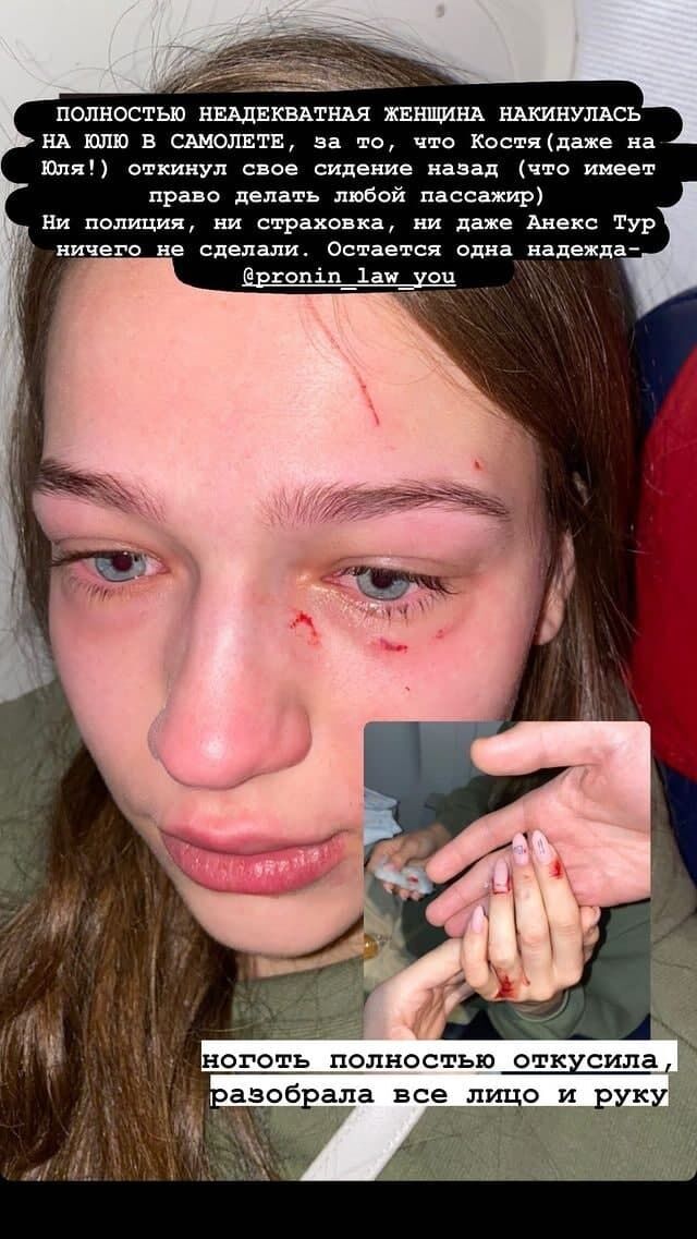 Юлии поцарапали лицо dqxikeidqxiqzant