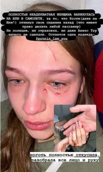 Юлия, которая пострадала во время конфликта в самолете dqxikeidqxiqzant