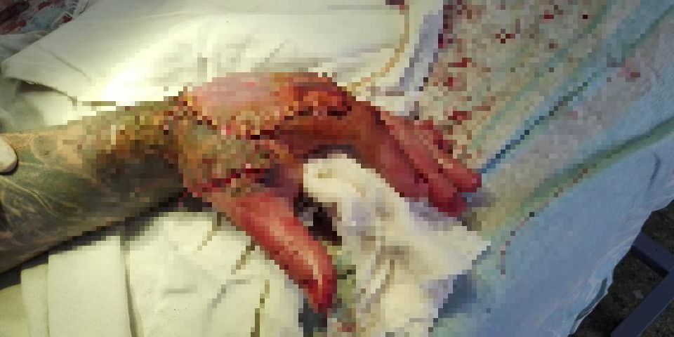 После операции. На руке видно швы