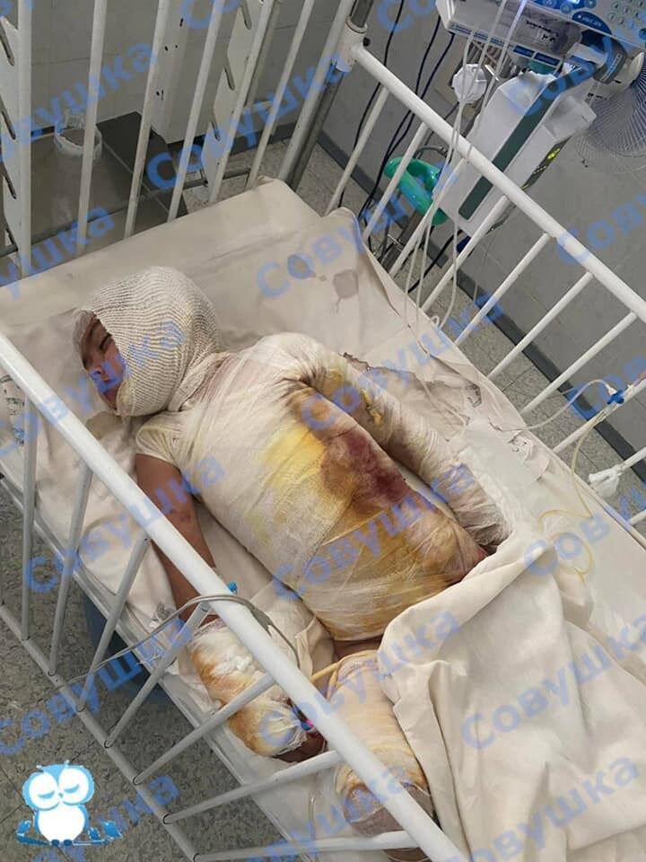 Ребенок получил 40% ожогов тела dqxikeidqxidqrant