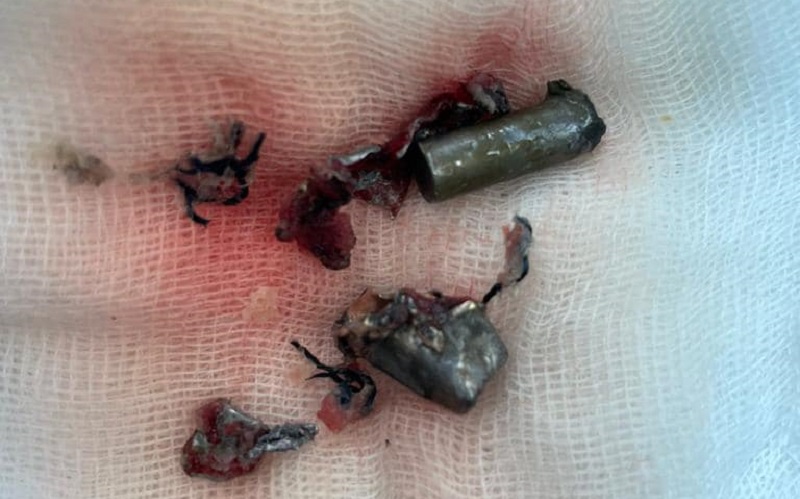 Глава МВД опубликовал фото пуль, которые достали из водителя Шефира - 1 - изображение dqxikeidqxidqeant