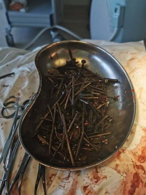 Из желудка мужчины достали более килограмма гвоздей dqxikeidqxidqrant