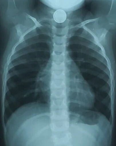 Батарейка пробыла в пищеводе малыша полтора часа dqxikeidqxidqrant