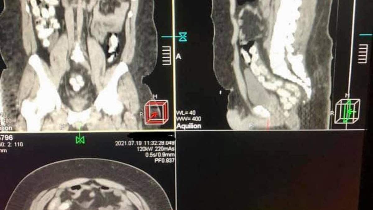 Бразилец хотел ввезти в Украину килограмм кокаина в желудке: дело направили в суд dqxikeidqxidqrant