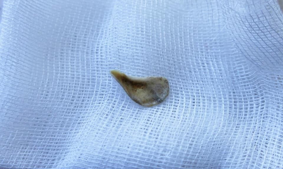 Кость, которая месяц была в дыхательных путях женщины dqxikeidqxidqeant