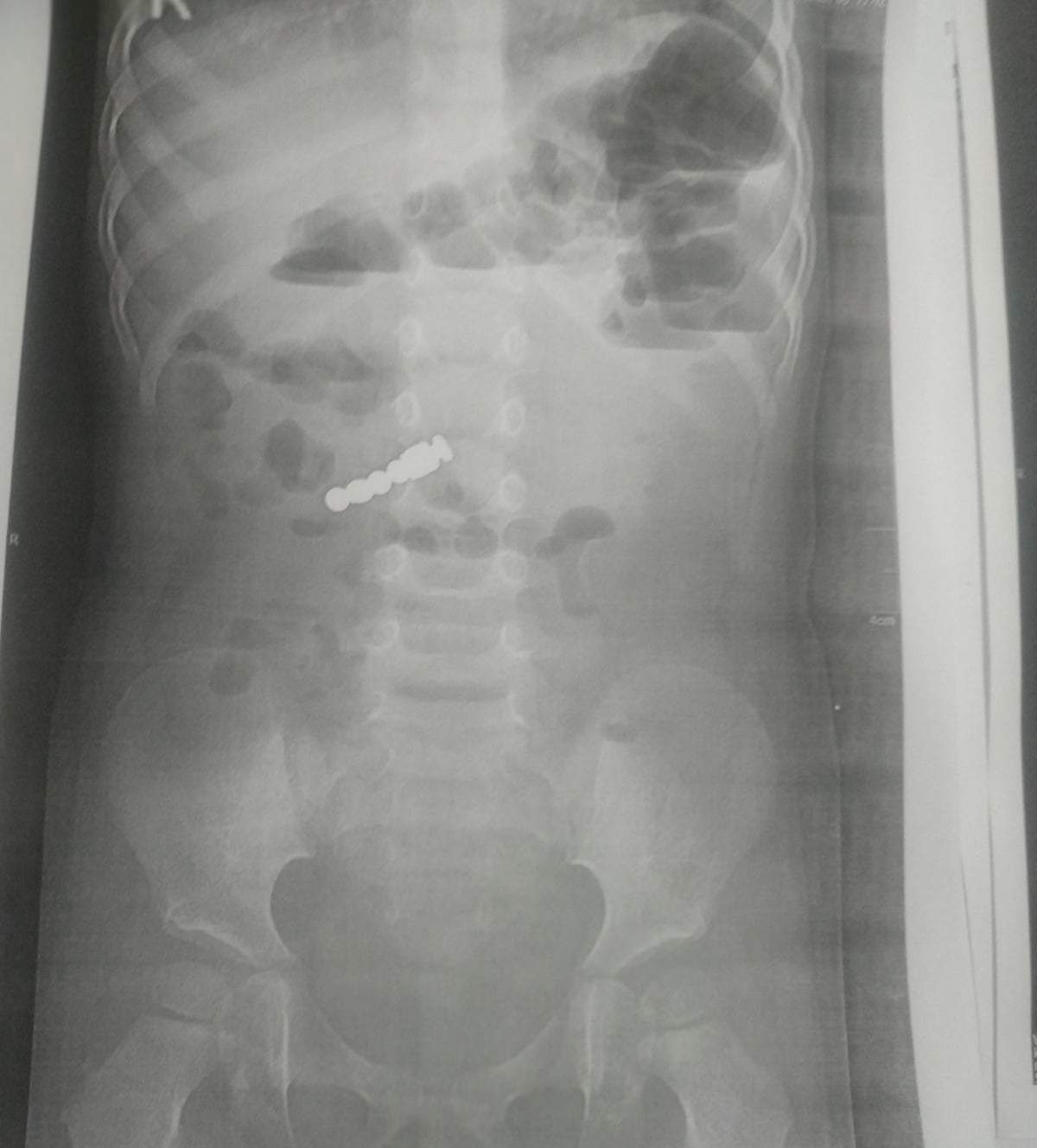 Проковтнула небезпечну іграшку: львівські лікарі врятували 2-річну дівчинку Проковтнула небезпечну іграшку: львівські лікарі врятували 2-річну дівчинку dqxikeidqxidqeant