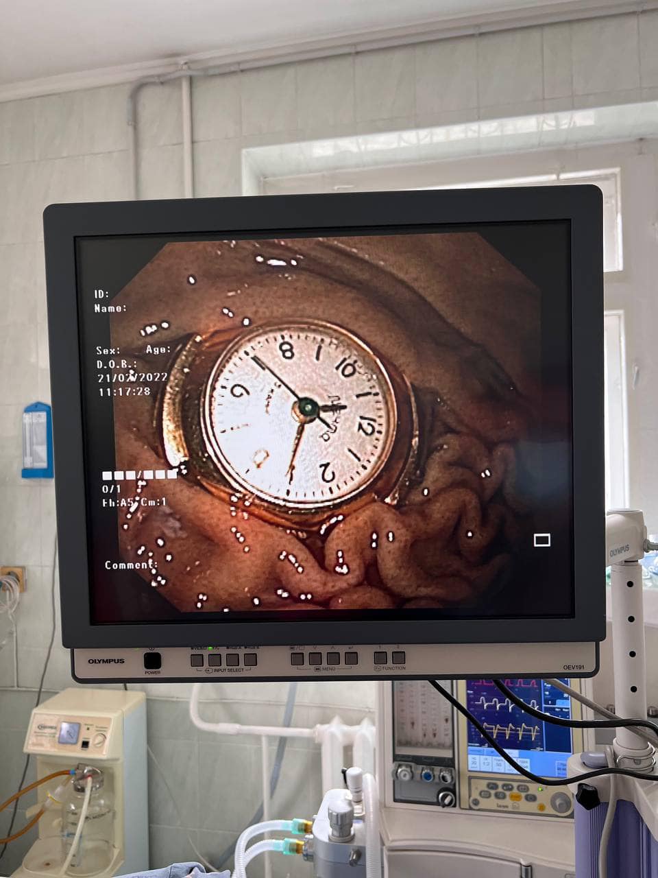 В Киеве врачи спасли 3-летнего мальчика, который проглотил часы (фото) dqxikeidqxidqrant