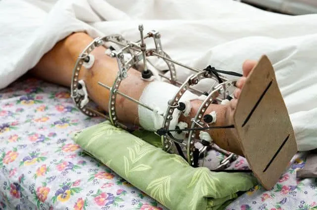 Раненым военным для спасения конечностей необходимы АВФ: волонтер обратилась за помощью