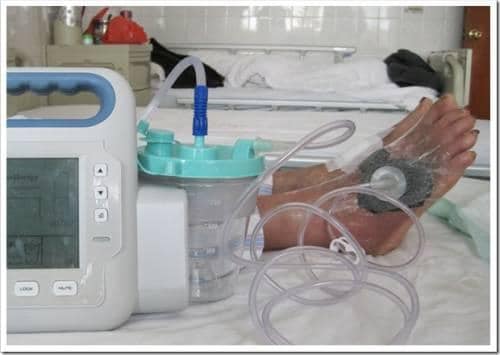 Сотни раненых: волонтеры просят помощи на покупку аппаратов ВАК dqxikeidqxidqrant