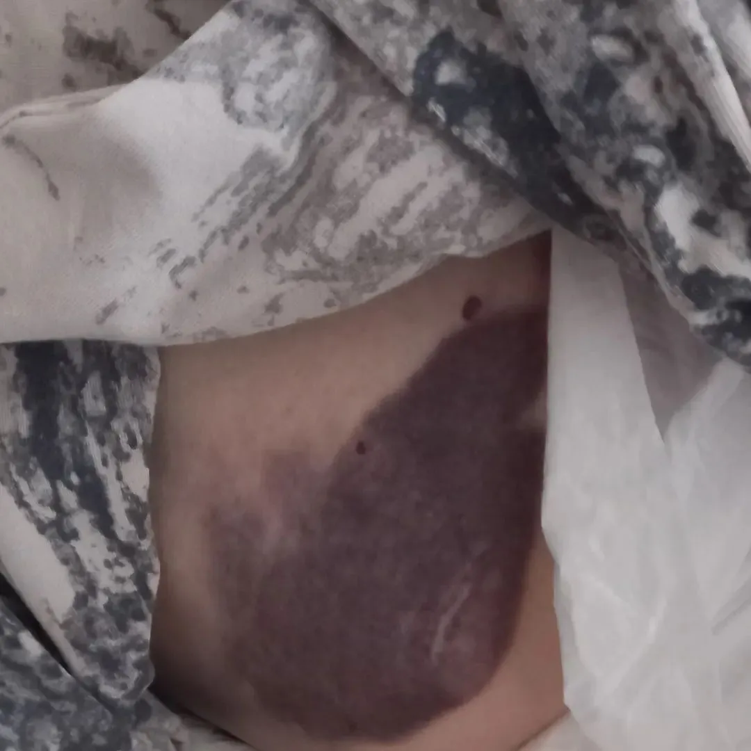 У пенсионерки синяки и гематомы dqxikeidqxidqeant