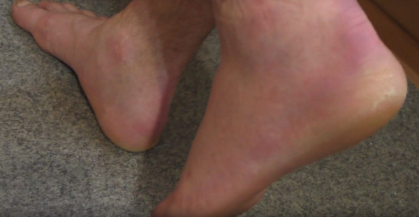 Синяки на ногах