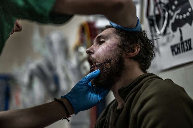 Поранення обличчя