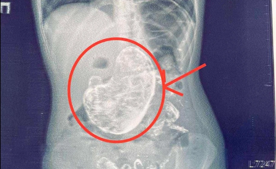 волосся у шлунку dqxikeidqxidqrant