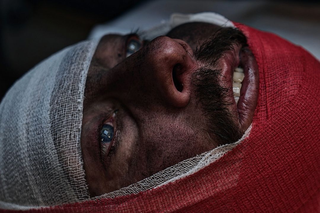 Пулевое ранение в голову, нет части челюсти: как медики спасают жизнь воинов на Кураховском направлении. Фото