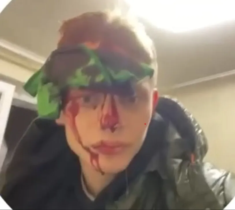 Непереможний український боксер постраждав від ракетного удару по Сумах: кров заливала обличчя чемпіона після влучання балістики dqxikeidqxiqtrant