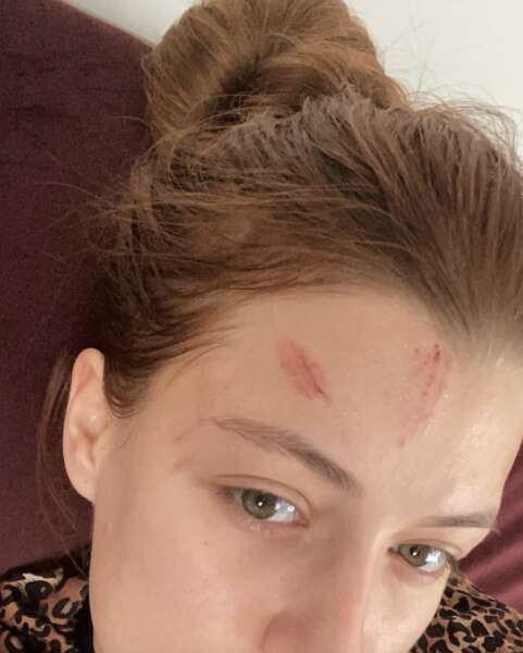 анастасия суббота синяки dqxikeidqxidqrant