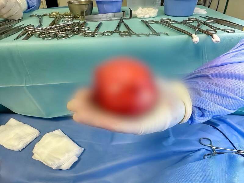 Врач: Наша команда с трудом вытащила эту опухоль через разрез, потому что она была размером с целую ладонь. Для такого крошечного тела это очень много