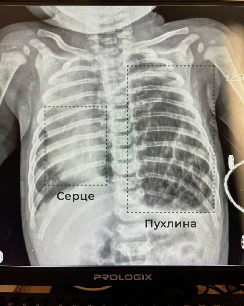 «Пухлина була розміром з долоню». У Львові медики врятували немовля фото 1 dqxikeidqxidqeant