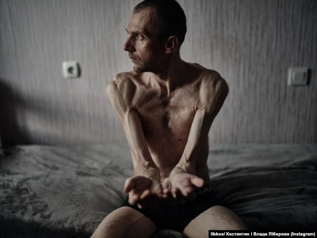 Ukrainian soldier after Russian captivity