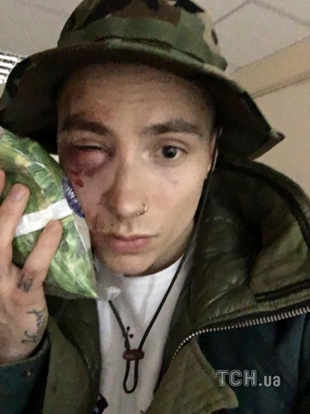 побитий учасник Quest Pistols Show_3 dqxikeidqxidqeant