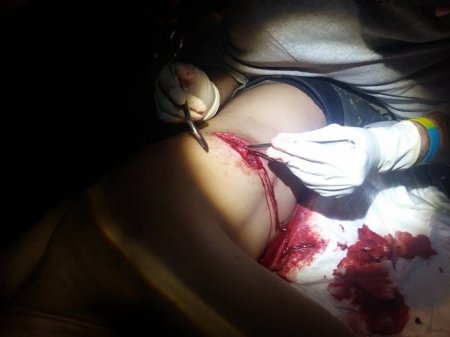 Моторошні кадри реалій війни оприлюднив хірург 128-ї бригади Моторошні кадри реалій війни оприлюднив хірург 128-ї бригади